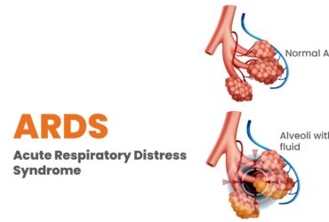 Acute Respiratory Distress Syndrome (ARDS)