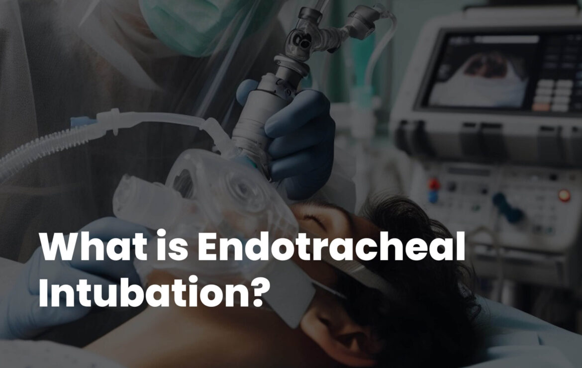 What is Endotracheal Intubation?